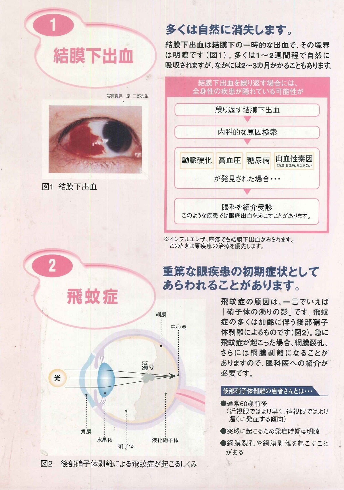 の 出血 原因 白目 左右の白目が真っ赤になる結膜下出血、何度も起こり心配：朝日新聞デジタル
